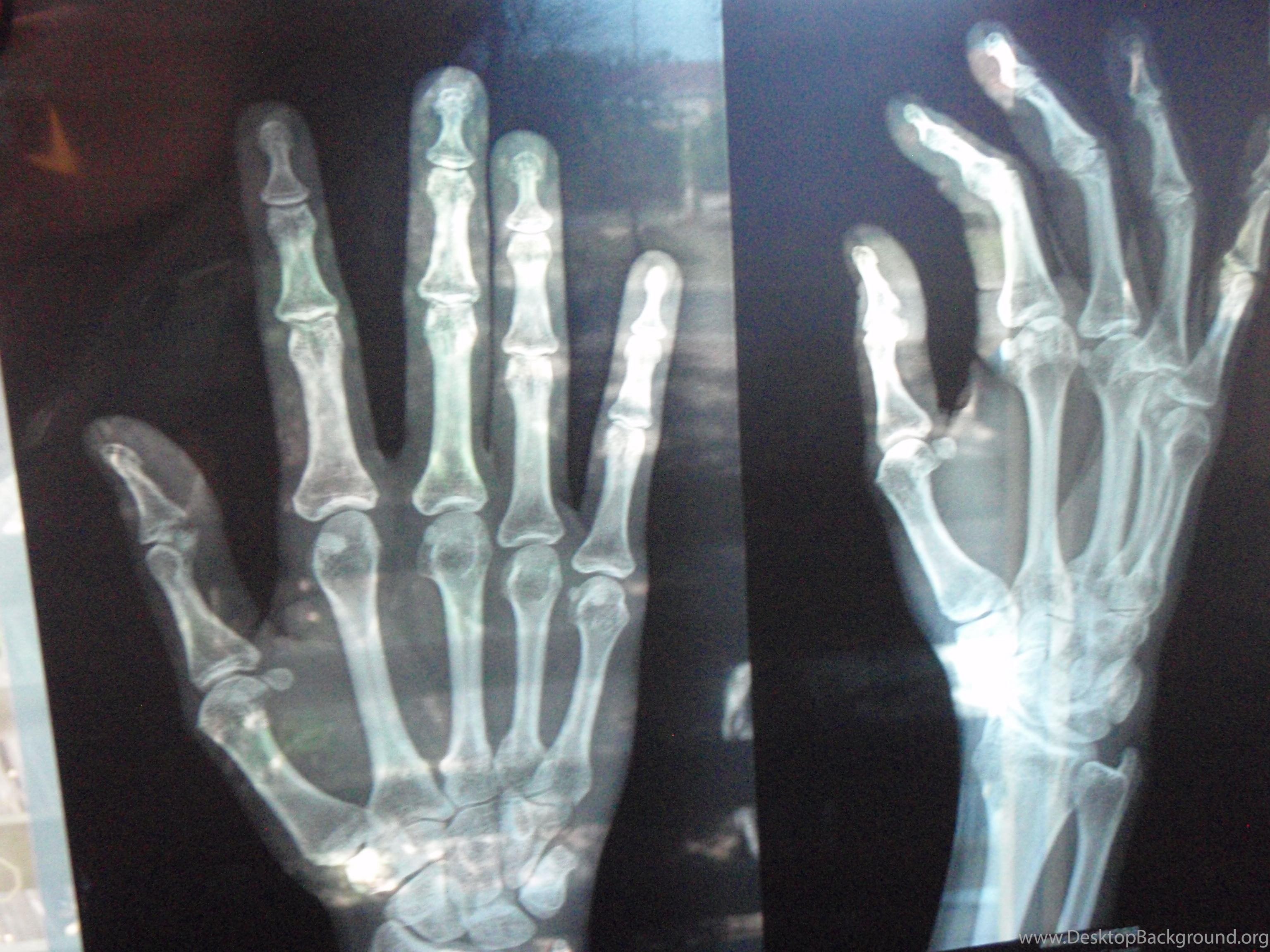 Как определить трещину в кости. Перелом фаланги пальца на руке рентген. Перелом мизинца руки регген. Перелом фаланги мизинца рентген. Перелом фаланг пальцев кисти рентген.