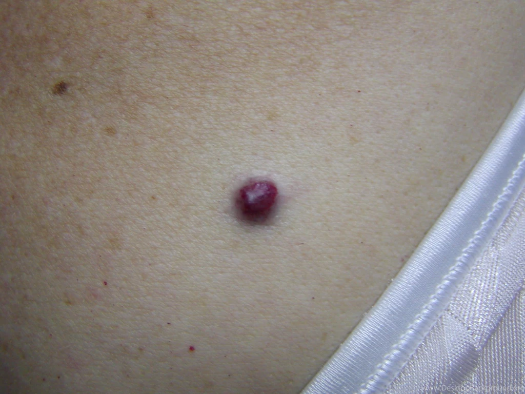Wallpapers Small Vagina Cherry Angioma Pictures 1094041.6 ...
