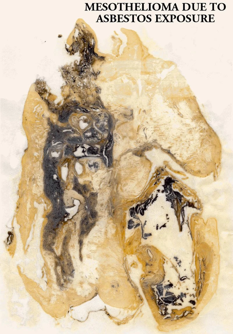Mesothelioma Asbestos