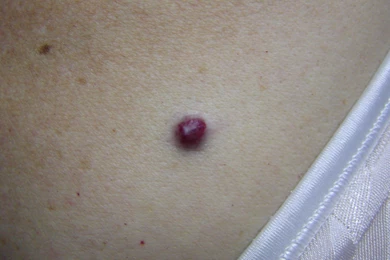 Wallpapers Small Vagina Cherry Angioma Pictures 1094041.6 ...