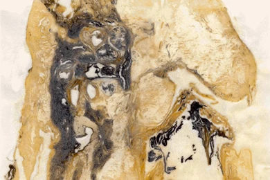 Mesothelioma Asbestos